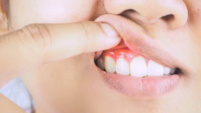 الصحة العالمية: أمراض الفم تصيب ما يقرب من نصف البشرية