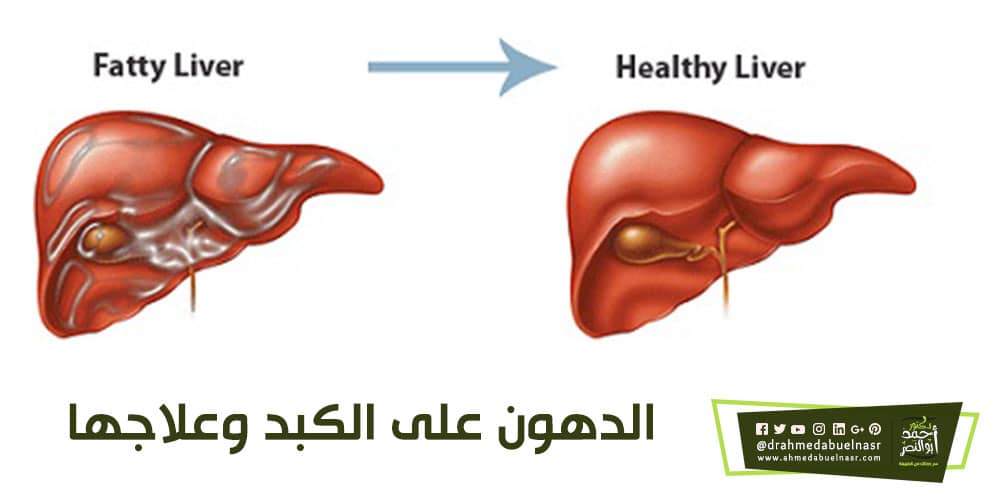 تعرف على الطرق الطبيعية لعلاج دهون الكبد