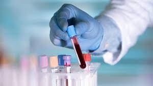 اختبار دم بسيط يقلب الموازين ويكتشف السرطان ويحدد مكانه